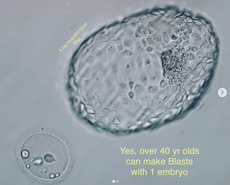 Post image - Advanced Age and Going to Blastocyst for ET