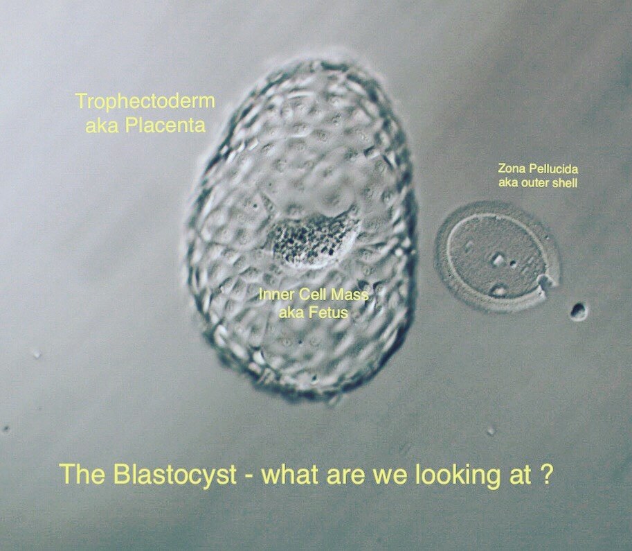 Post image - What are we looking for in a Blastocyst?